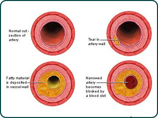 hd_cholesterol_illustration_02