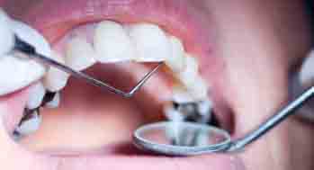 toothcleaning