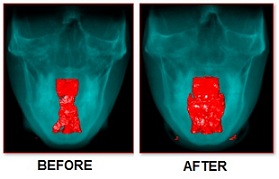 DNA-Appliance-3D-Image-Increased-Airway