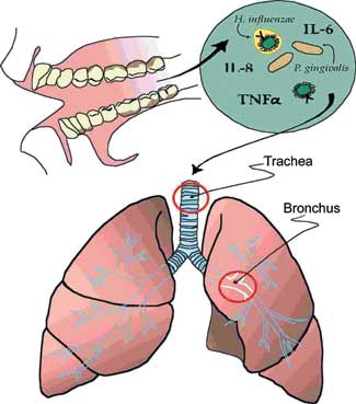 Periodontal Disease and Respiratory Disease: a Systematic Review of the Evidence” by Brooke Agado and Denise Bowen