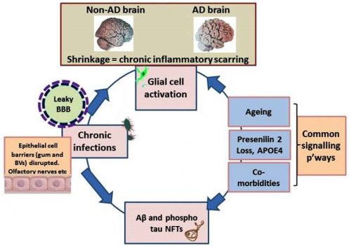 Periodontitis, Microbiomes and their Role in Alzheimer’s Disease